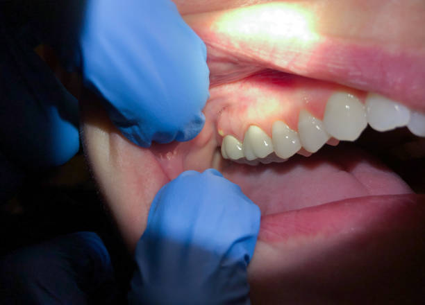 Best Knocked-Out Tooth (Avulsed Tooth) Treatment in Ravenel, SC